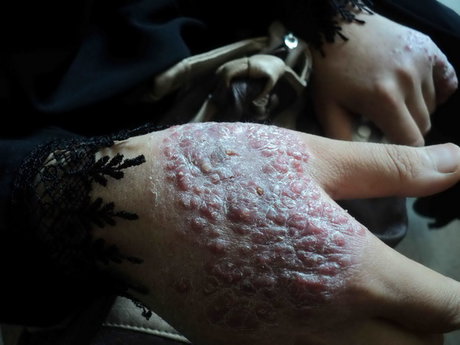 ابتلای حدود 650 نفر به سالک در خوزستان/ درمان رایگان بیماران مبتلا
