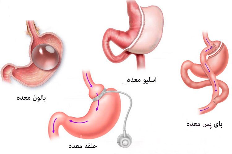 عوارض و مزیت اسلیو معده