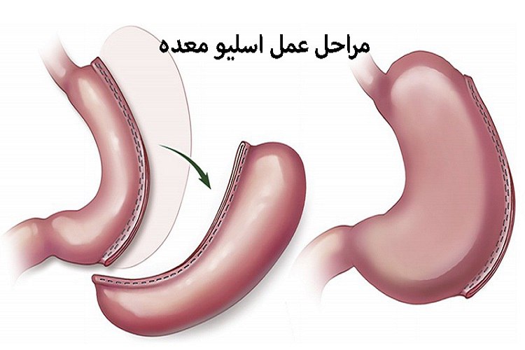 مراحل انجام اسلیو معده