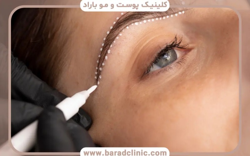 روش های نوین کاشت ابرو ، آنچه پیش از کاشت باید بدانید روش های نوین کاشت ابرو ، آنچه پیش از کاشت باید بدانید