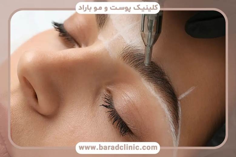 روش های نوین کاشت ابرو ، آنچه پیش از کاشت باید بدانید روش های نوین کاشت ابرو ، آنچه پیش از کاشت باید بدانید