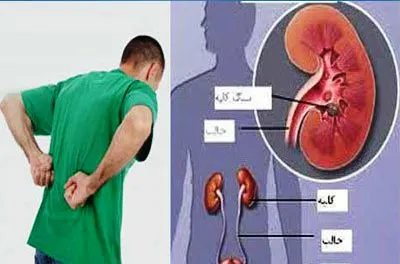 همه آنچه باید درباره سنگ کلیه بدانید