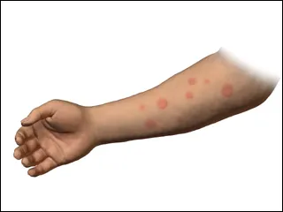 درباره بیماری کهیر بیشتر بدانیم